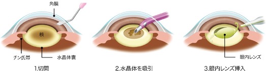 図：目の手術