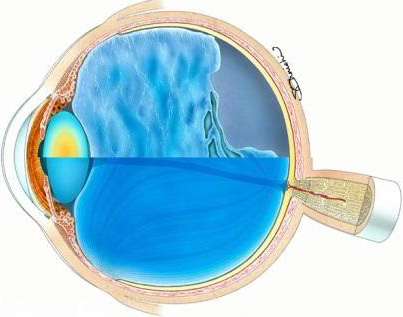図：網膜剥離