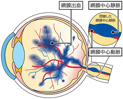 図：網膜中心静脈閉塞症