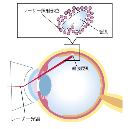 網膜剥離・網膜裂孔 | こいけ眼科