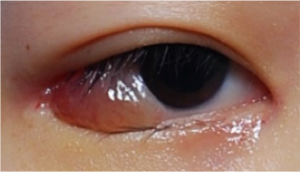 結膜浮腫とは こいけ眼科のお知らせ
